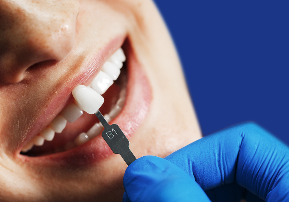 Dental Veneers